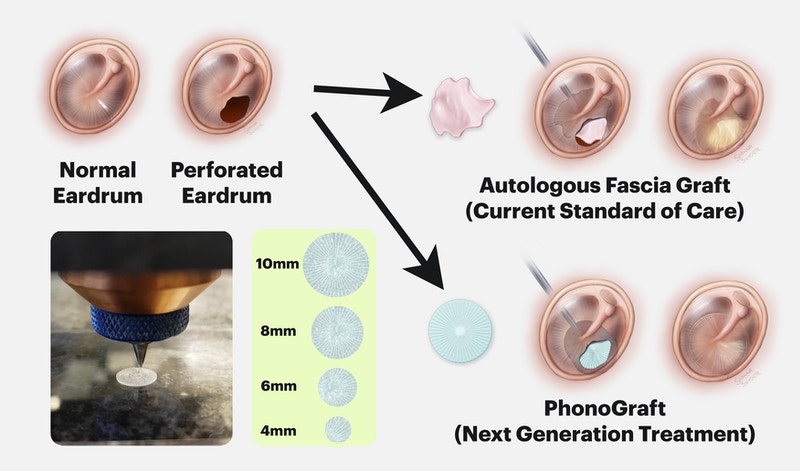 How PhonoGraft (blue) causes the function and form of the tympanic membrane to regenerate
