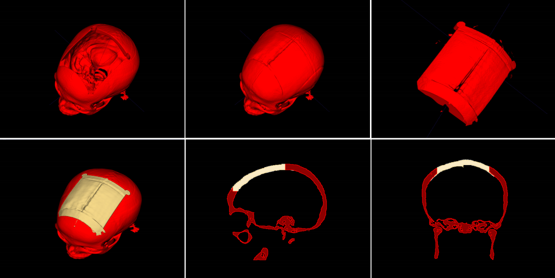  Researchers in Austria have developed an automated process that allows users to design skull implants