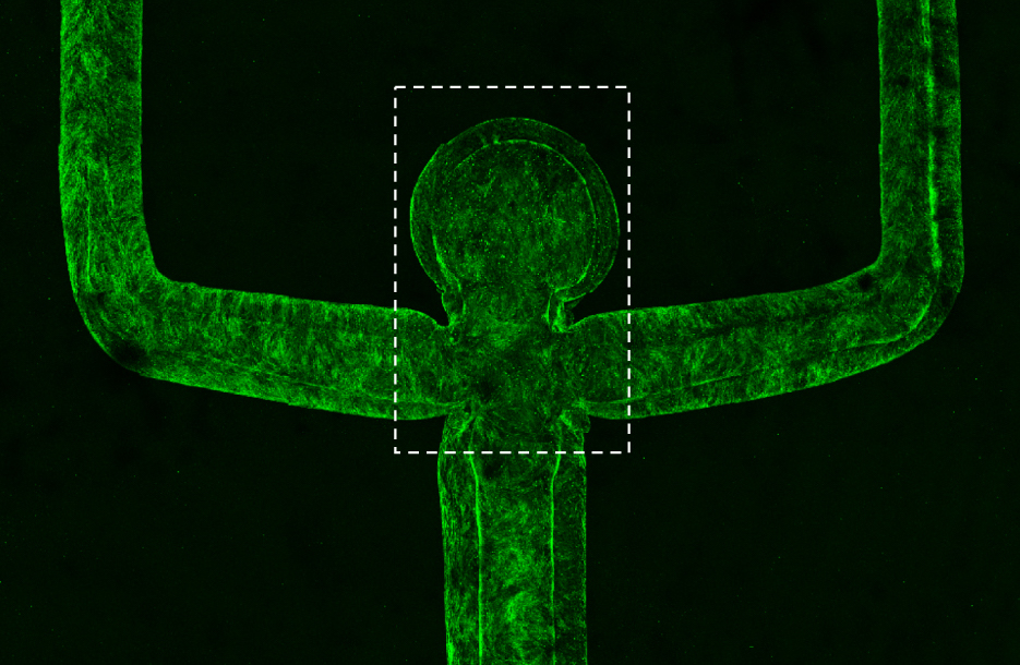 The researchers’ aneurysm The researchers’ aneurysm