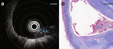 Images captured using the research team's endoscopic device show necrotic cores of dead cells