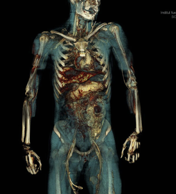  PMCTA of whole body showing contrasting blood vessels and organs